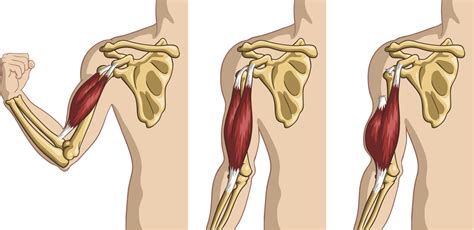 Bicep Tendon Tears And Tendonitis Austin Chen Md