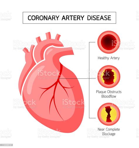 Human Heart With Coronary Artery Disease Info Graphic Stock