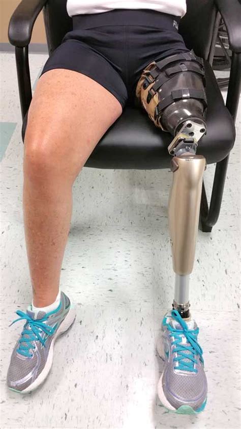Mary Prosthetic Leg Legs Prosthetics