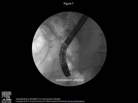 Common Bile Duct Intussusception During Ercp For Stone Removal Ppt