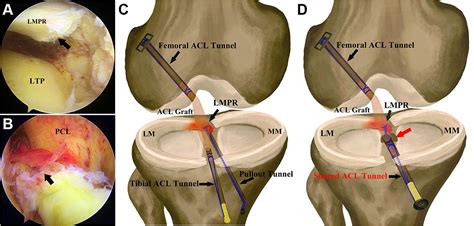 Shared Acl Bone Tunnel Technique For Repair Of Lateral Meniscus
