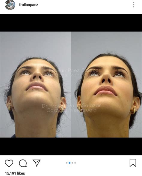 Before And After Photos Of Venezuelan Beauty Queens Circulate On Social