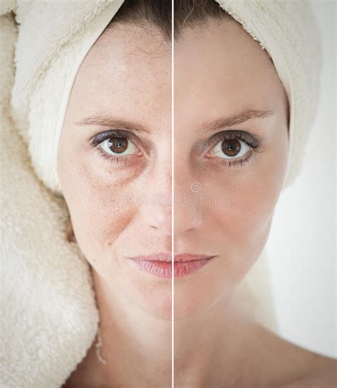 Beauty Concept Skin Aging Anti Aging Procedures Rejuvenation Lifting