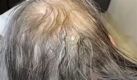 Infected Cyst On Scalp Drained New Pimple Popping Videos