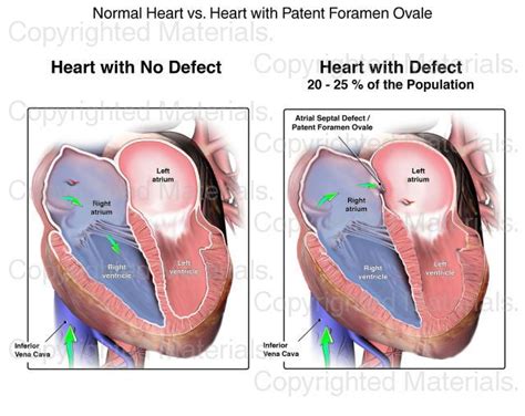 Normal Heart Vs Heart With Patent Foramen Ovale Atrial Septal Defect