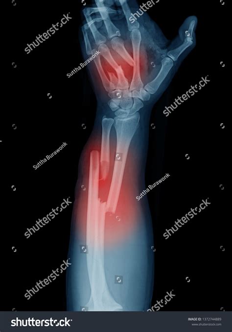 Broken Forearm Hand Xray Image Traffic Foto De Stock Editar Ahora