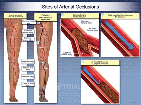 Sites Of Arterial Occlusions Trial Exhibits Inc
