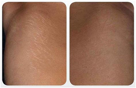 Stretch Mark Removal Medical Spas In New York Ny Dr Ww Medspa