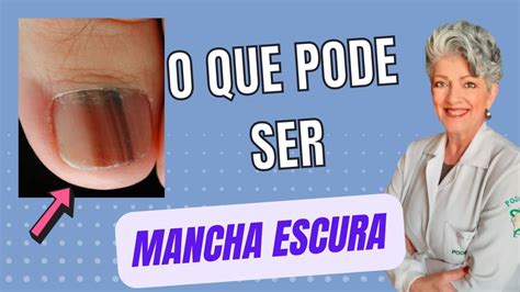 Manchas Escuras Nas Unhas
