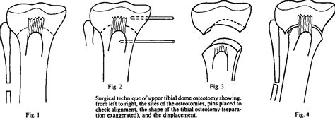 Table V From Dome Osteotomy Of The Tibia For Osteoarthritis Of The Knee