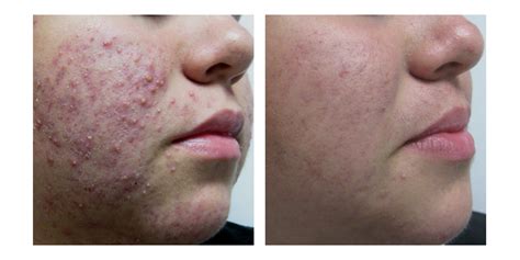 Cystic Acne Getting Clear Without Accutane Isotretinoin Vivant
