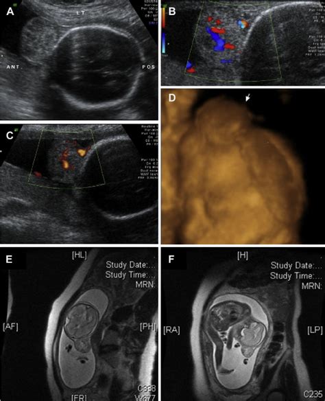 Us And Mr Images Of The Scalp Mass At 23 Weeks Gestation A A