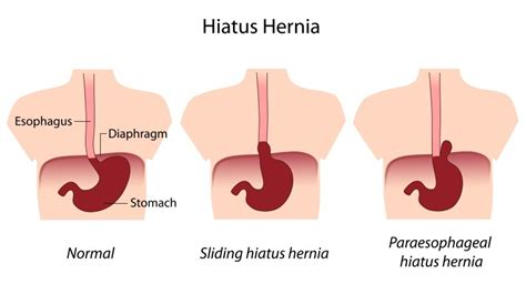 Is Gerd A Symptom Of A Hiatal Hernia Drcarney Com Blog Drcarney Com