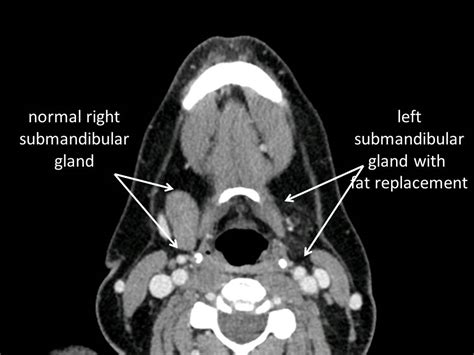 Salivary Gland Atrophy With Chronic Obstruction Iowa Head And Neck