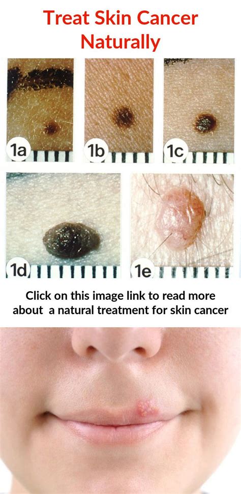 Find Out About A Natural Treatment For Skin Cancer