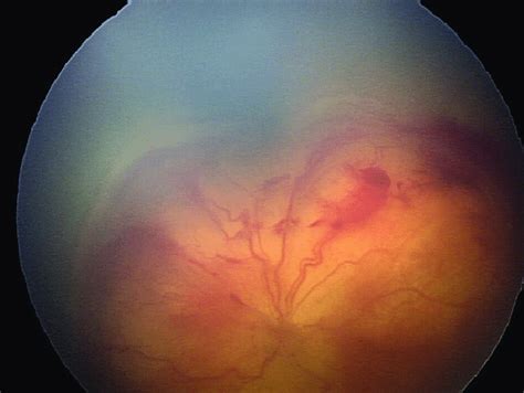 Extra Foveal Stage 4a Partial Retinal Detachment Download