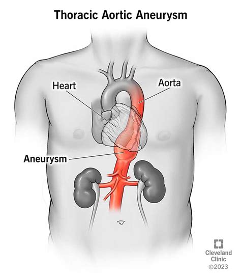 Chest Aortic Aneurysm Hot Sex Picture