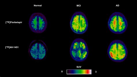 Applications Of Amyloid Tau And Neuroinflammation Pet Imaging To