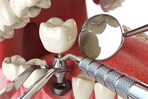 Dental Implants Procedure A Step By Step Guide Greater Essex Dental