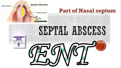 Septal Abscess Part Of Nasal Septum Youtube