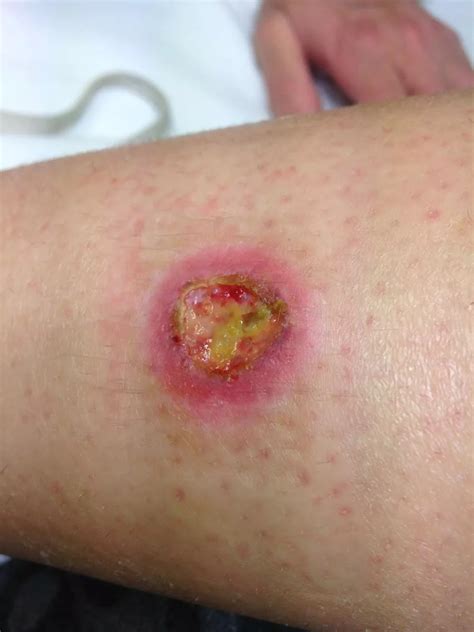 Infected Spider Bite Daily Record
