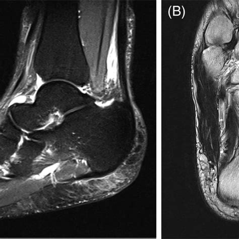 Cd Mri Images Demonstrating Non‐specific Oedema Within The Kager Fat