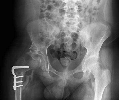 Developmental Dysplasia Of The Hip Prof Portinaro Orthopedic Suregon
