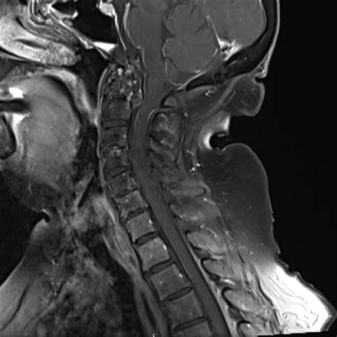 Mri Brain And Cervical Spine With And Without Contrast Brain Mri