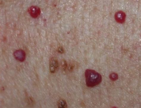 Red Spots On Legs Itchy Pictures Dots Patches Blotches Causes