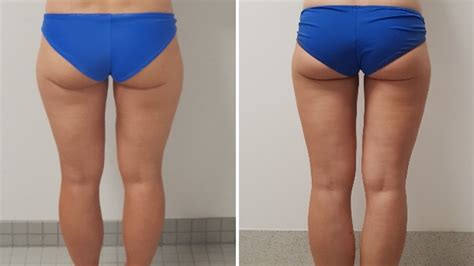 Fat Freezing Results Brisbane Does Coolsculpting Really Work The Courier Mail