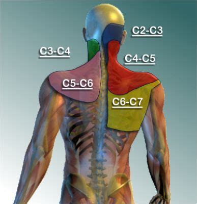 Outlined The Areas Of Referred Pain From Cervical Facet Syndrome CFS