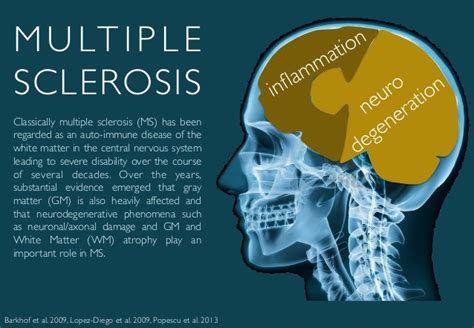 .mri scan of the brain, mri scan of the spine; Multiple Sclerosis: Introduction to Multiple Sclerosis