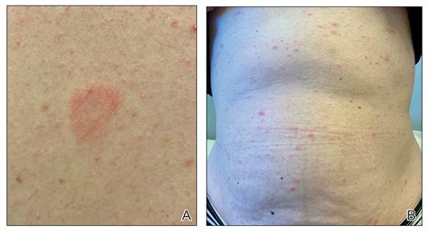 Pityriasis Rosea Associated With Covid 19 Vaccination A Common Rash