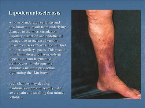 Ppt Chronic Venous Insufficiency Powerpoint Presentation Free