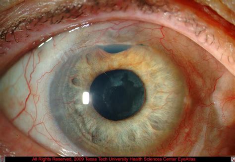 Iris And Ciliary Body Glaucoma Uveitis Texas Tech University