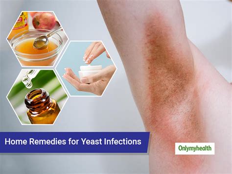 Home Remes To Cure Fungal Infection On Skin My Bios