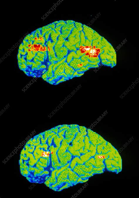 Pet Scan Of Depressed And Normal Brain Stock Image