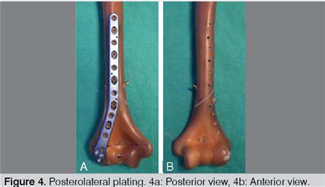 Figure From A New Anatomical Plate For Extra Articular Distal Humeral Fractures Biomechanical
