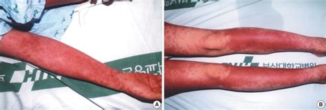 Diffuse Erythema On The Patients Right Arm A And Both Legs B