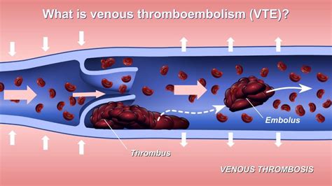 Thrombosis Vs Embolism The Critical Differences