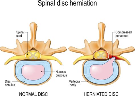 Cervical Radiculopathy And Herniated Disc Antonio Webb Neck Back