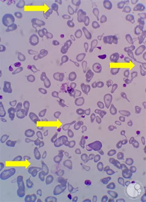 Hbh Disease With Teardrop Cell Presentation In Pbs