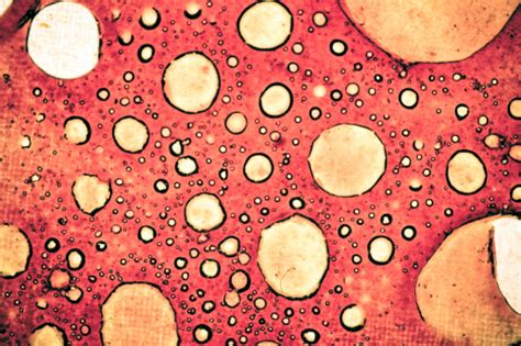 La leucémie myéloïde chronique se caractérise par la production excessive de globules blancs. Je m'informe sur la LMC : Leucémie Myéloïde Chronique - Le ...