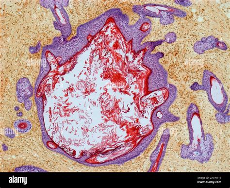 Dermoid Ovarian Cyst Light Micrograph Of A Section Through An Ovary