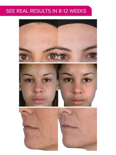 Pmd Personal Microderm Pro Before And After Hoolioil