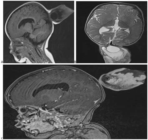Brain Mri A Sagittal Section T1 B Axial Section T2 An Occipital