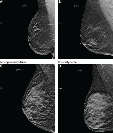 Breast Cyst Mammogram