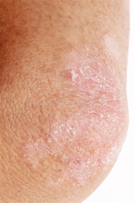 Psoriasis On Elbow Stock Image Image Of Peeling Dermatology 40723091
