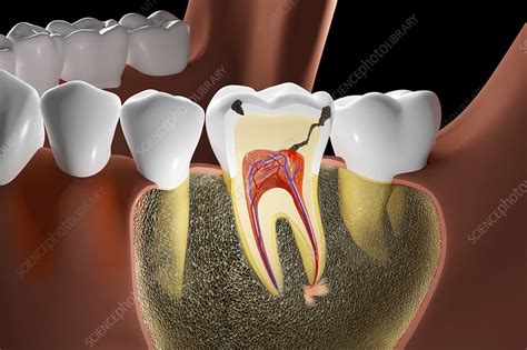 Tooth Decay Illustration Stock Image C0391612 Science Photo Library
