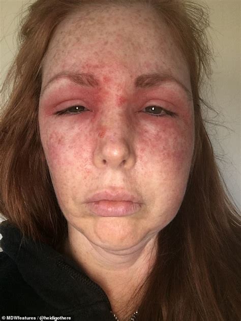 Woman Wakes Up With Black Eye And Swollen Face After Cat Scratch That